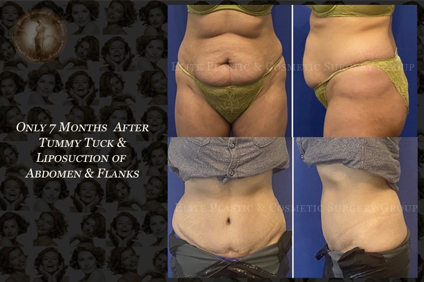 Best Abdominoplasty surgery clinic in Dubai Best Abdominoplasty surgery clinic in Dubai